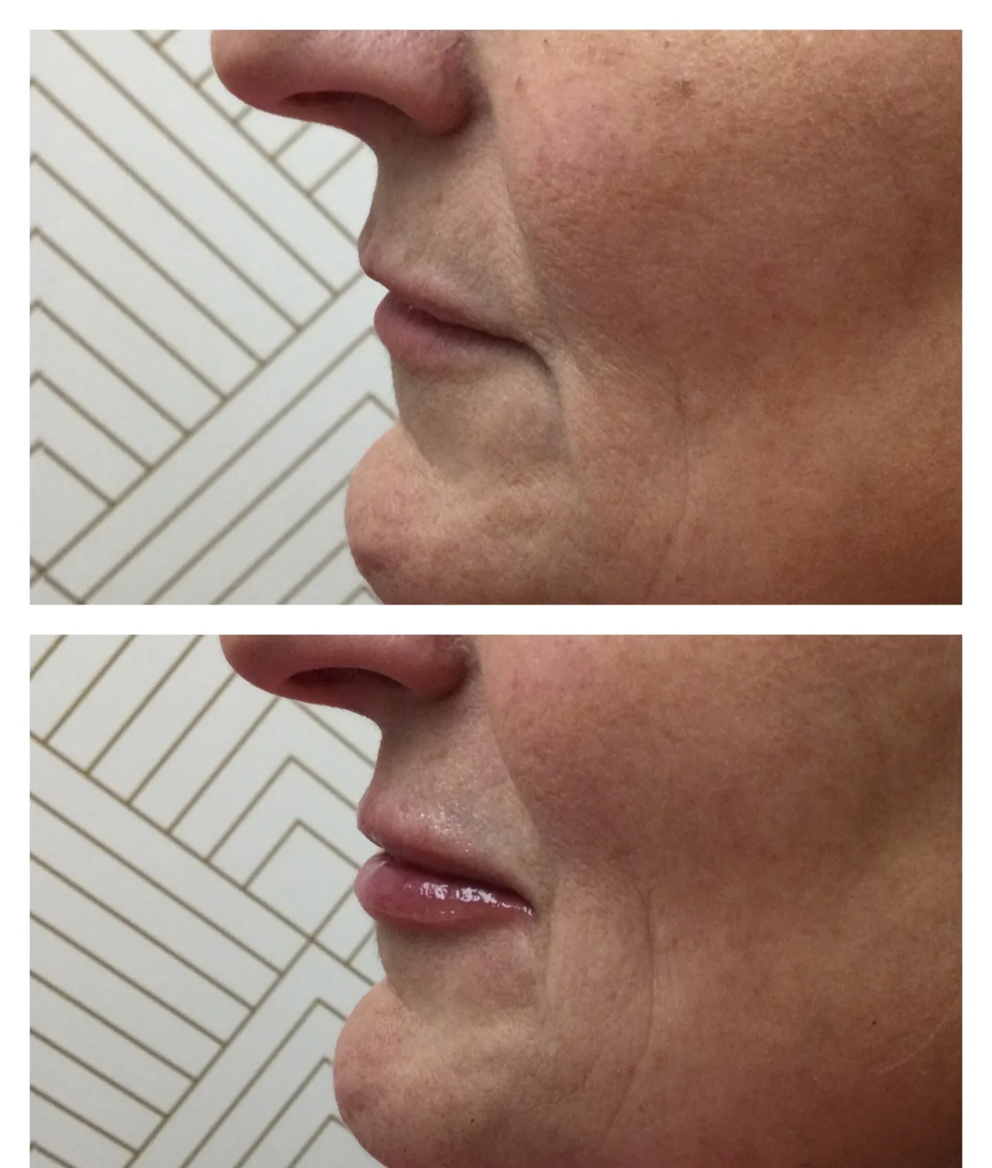 beautybaraestheticsmedspa-lip-fillers